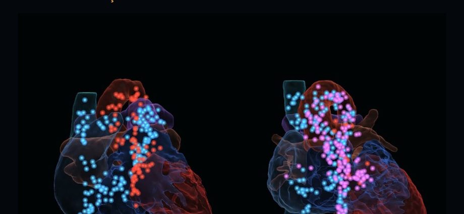 Dois corações reais de crianças em 3D, de vidro, com partículas de sangue: à esquerda um coração normal, à direita uma transposição das grandes artérias